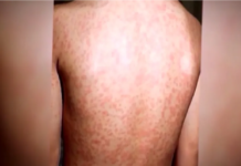 Condado Cameron confirma un caso de sarampión; activan investigación