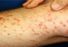 Alertan sobre bacteria transmitida por pulgas más de 7 mil casos en el Valle
